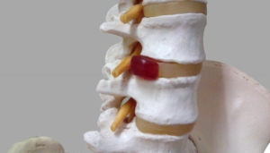 脊柱管（神経の通り道）が挟まり、その中を通る神経を圧迫するため、症状がでてきます。